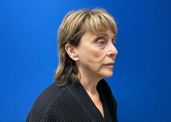 Facelift Before & After