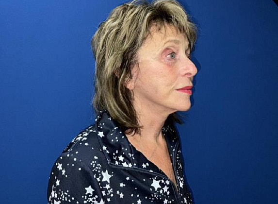 Facelift Before & After