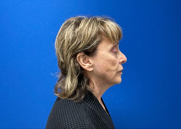 Facelift Before & After