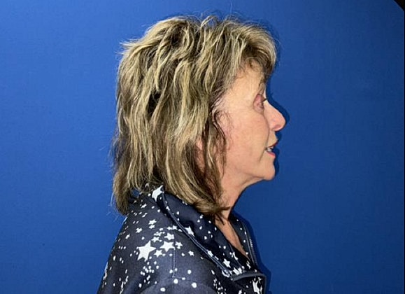 Facelift Before & After