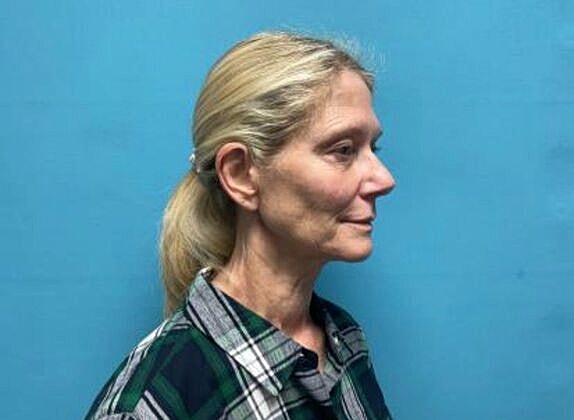 Facelift Before & After