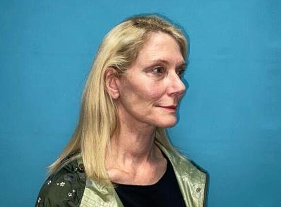 Facelift Before & After