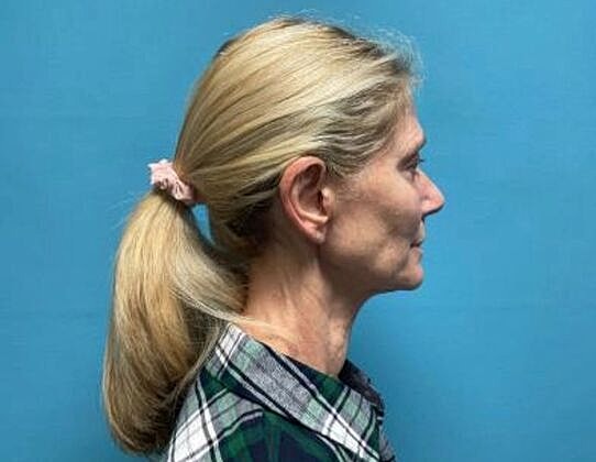 Facelift Before & After