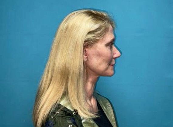 Facelift Before & After
