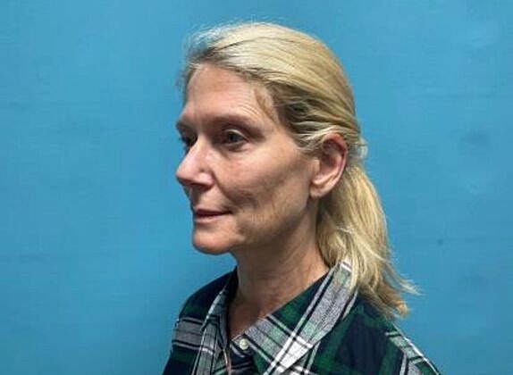 Facelift Before & After