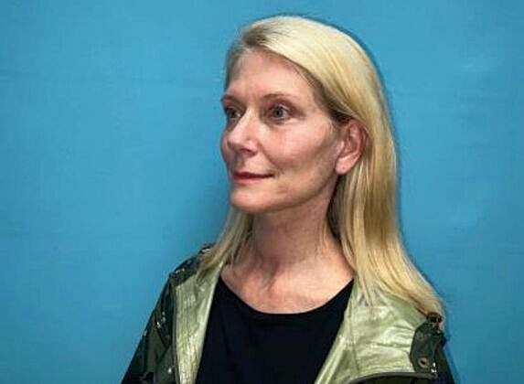 Facelift Before & After