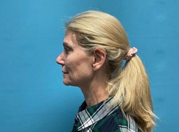 Facelift Before & After