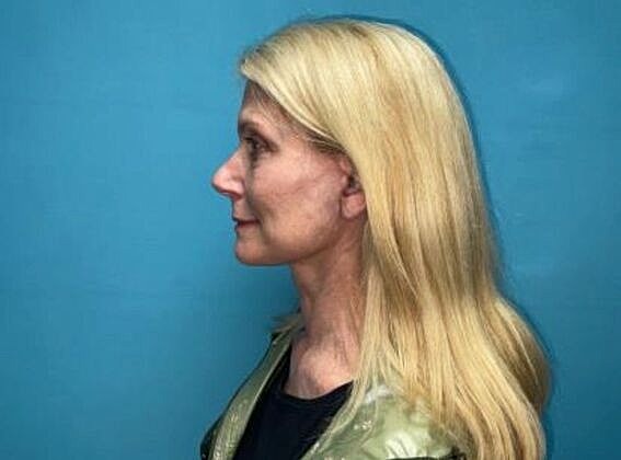Facelift Before & After