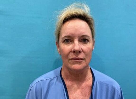 Facelift Before & After