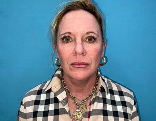Facelift Before & After
