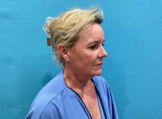 Facelift Before & After