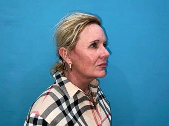 Facelift Before & After