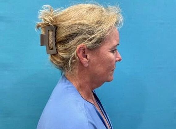 Facelift Before & After