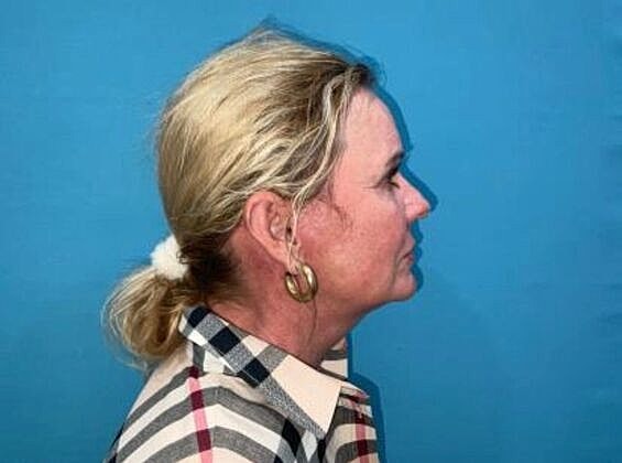 Facelift Before & After