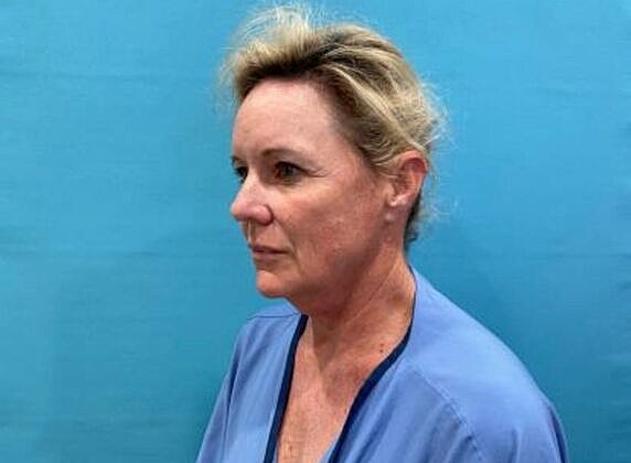 Facelift Before & After