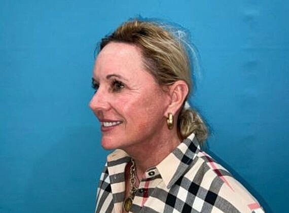 Facelift Before & After