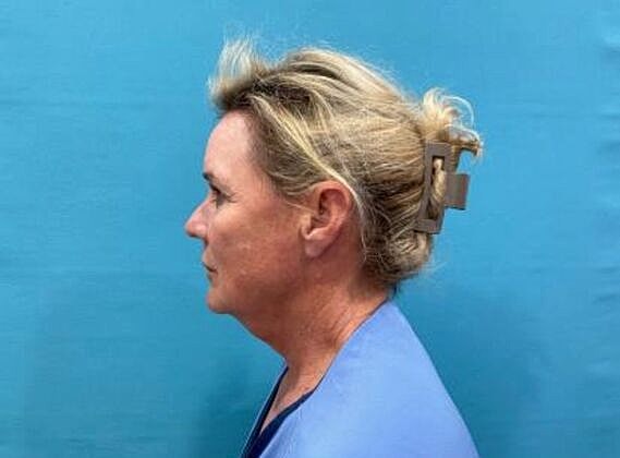 Facelift Before & After