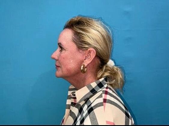 Facelift Before & After