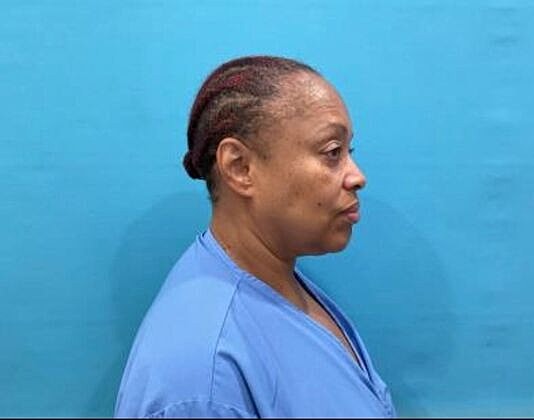 Facelift Before & After