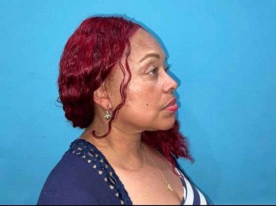 Facelift Before & After