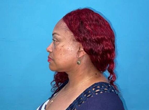 Facelift Before & After