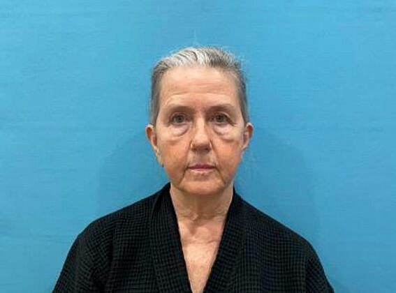 Facelift Before & After