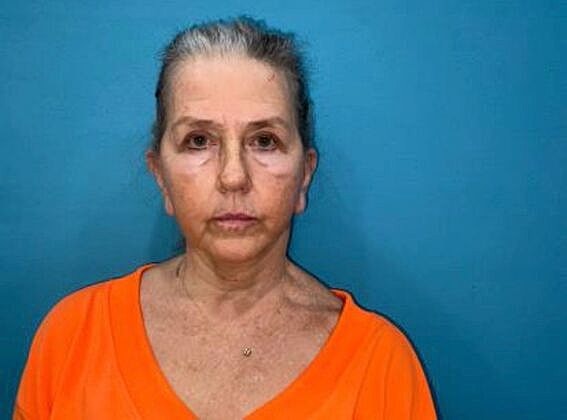 Facelift Before & After