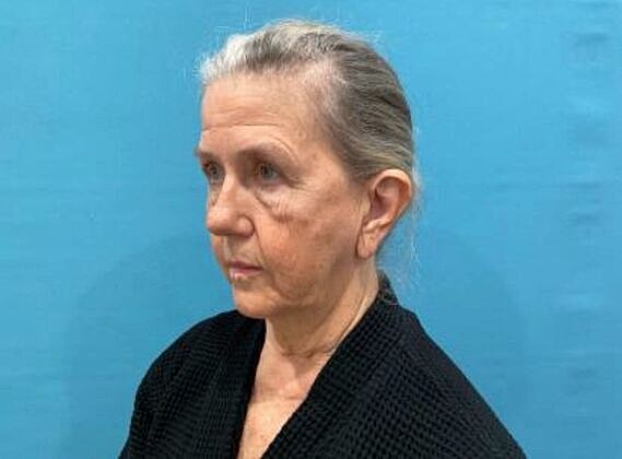 Facelift Before & After