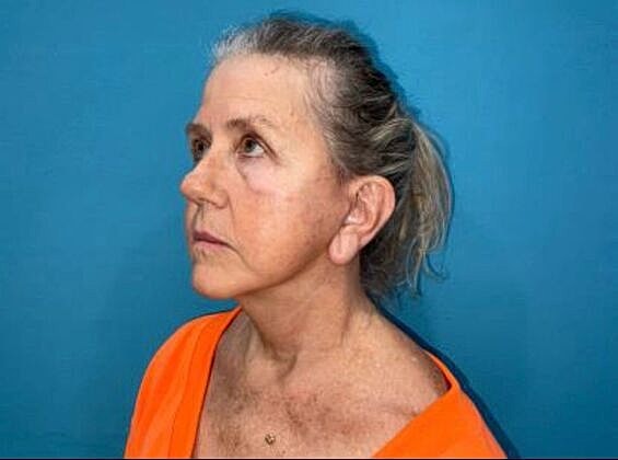 Facelift Before & After