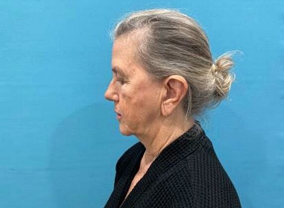 Facelift Before & After