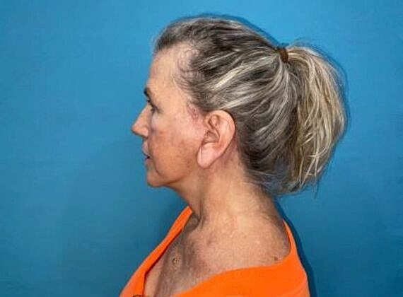 Facelift Before & After