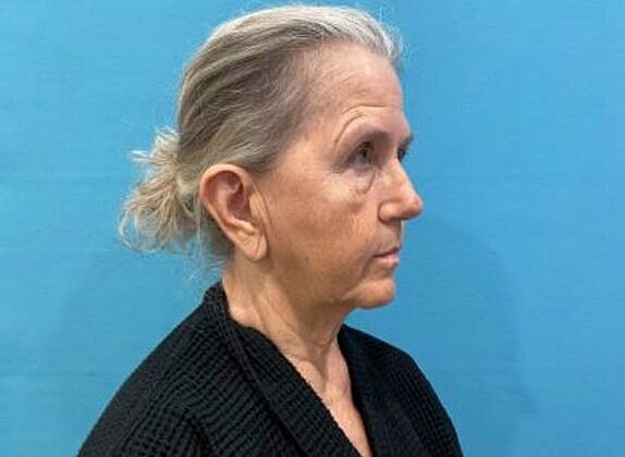 Facelift Before & After
