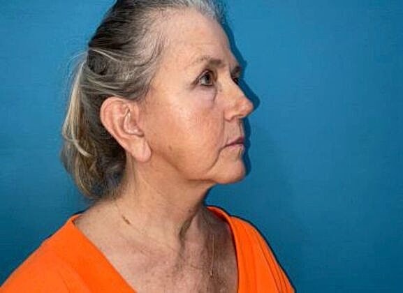 Facelift Before & After