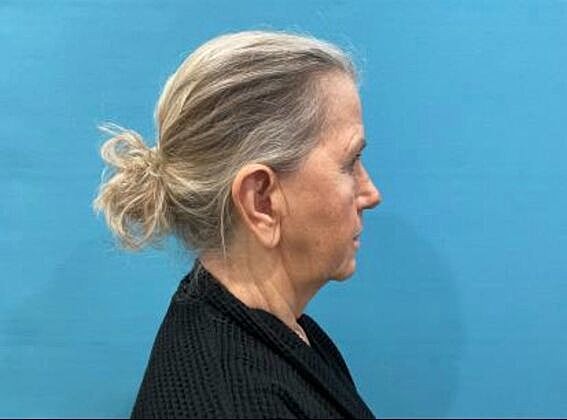 Facelift Before & After