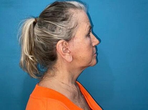 Facelift Before & After