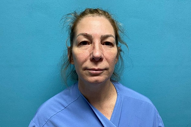 Blepharoplasty Before & After