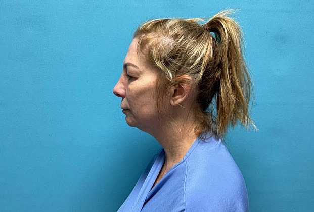 Blepharoplasty Before & After