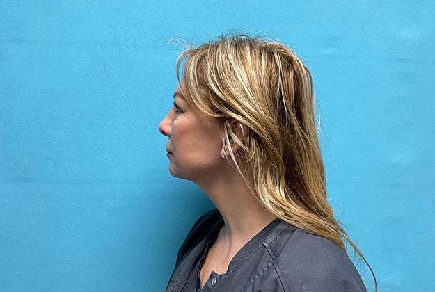 Blepharoplasty Before & After