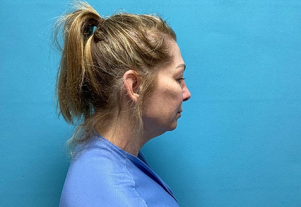 Blepharoplasty Before & After