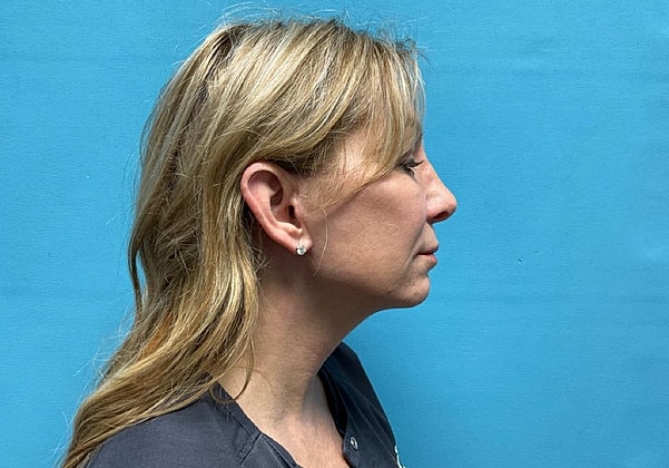 Blepharoplasty Before & After