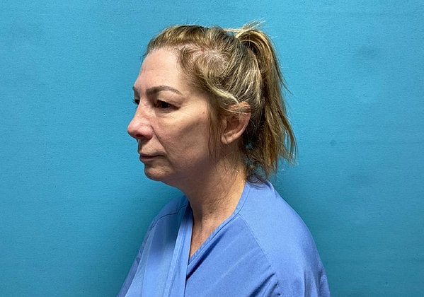 Blepharoplasty Before & After