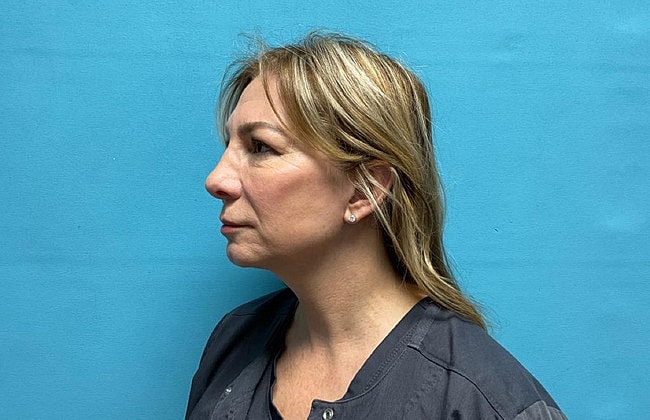 Blepharoplasty Before & After