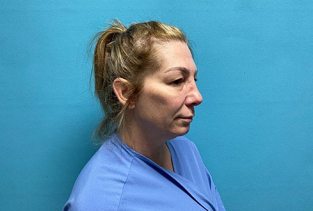 Blepharoplasty Before & After