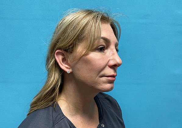 Blepharoplasty Before & After