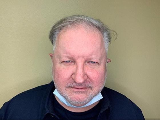 Blepharoplasty Before & After