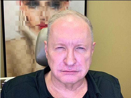 Blepharoplasty Before & After