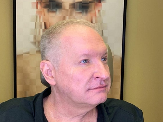 Blepharoplasty Before & After