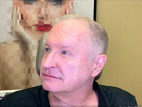 Blepharoplasty Before & After