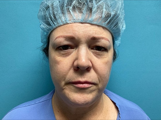 Blepharoplasty Before & After