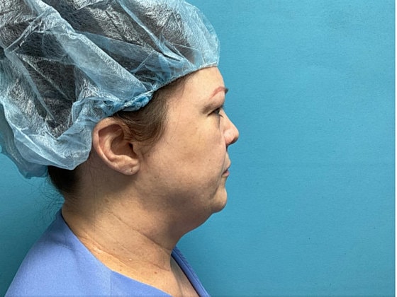 Blepharoplasty Before & After